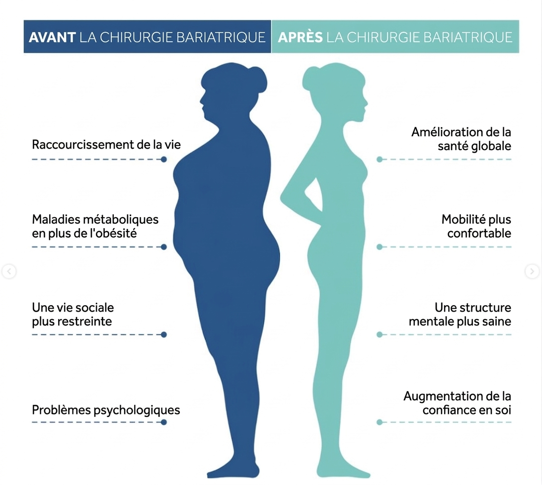 Avant et après chirurgie bariatrique : risques de l’obésité vs bénéfices – Istanbul Hospital